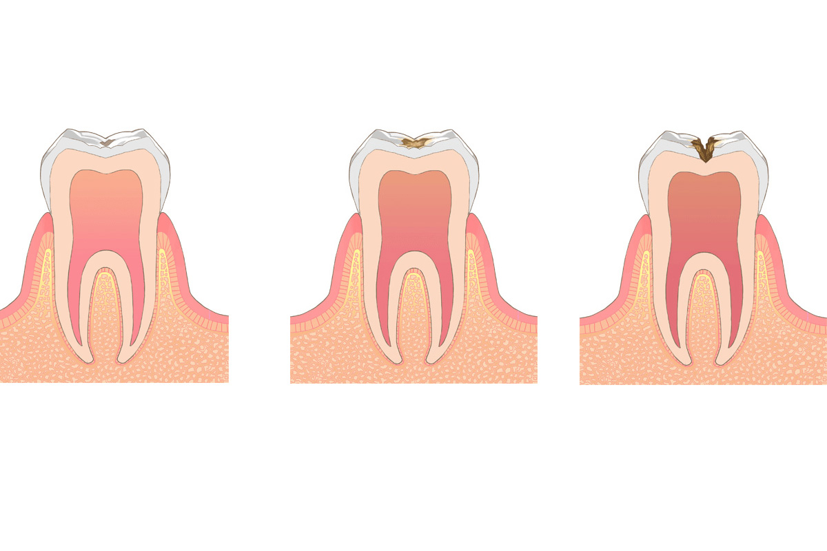みまや歯科クリニック 自覚症状がなくてもむし歯はある