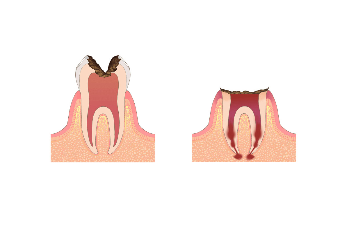 みまや歯科クリニック しみたり、痛みを感じたらもう手遅れ！