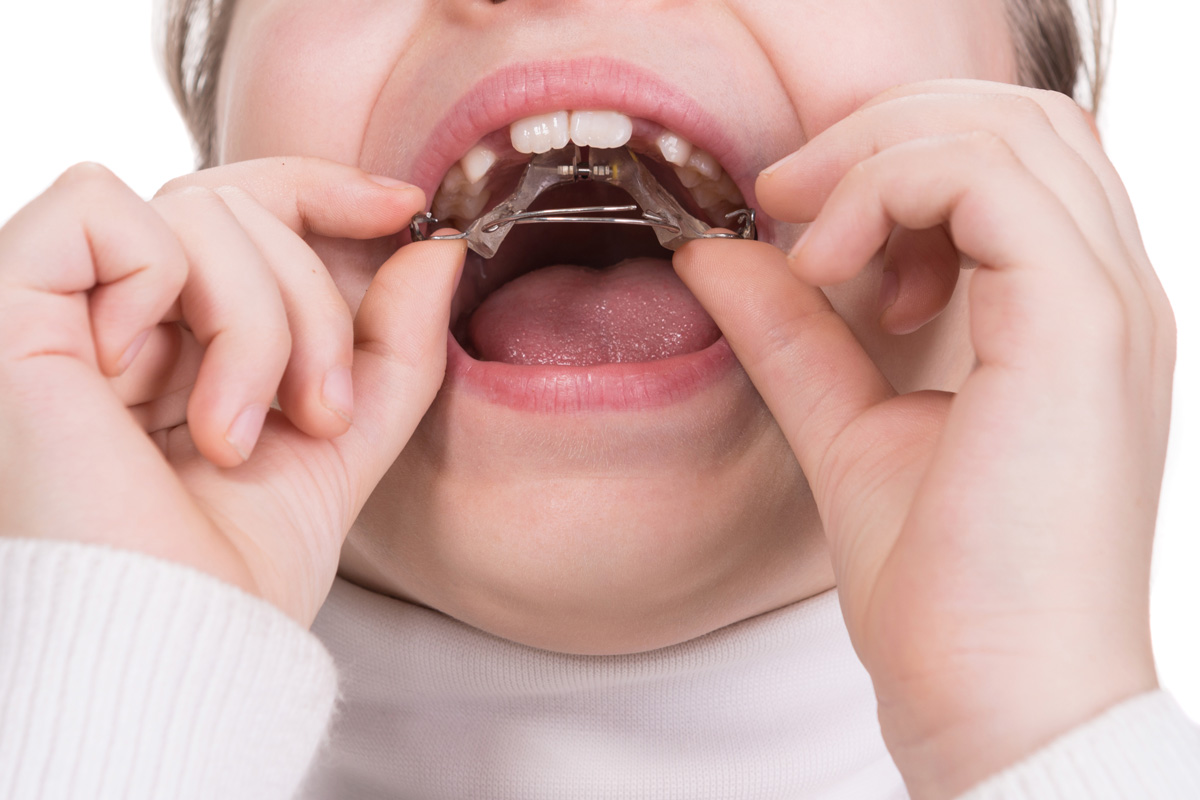 みまや歯科クリニック 保隙装置（ほげきそうち）