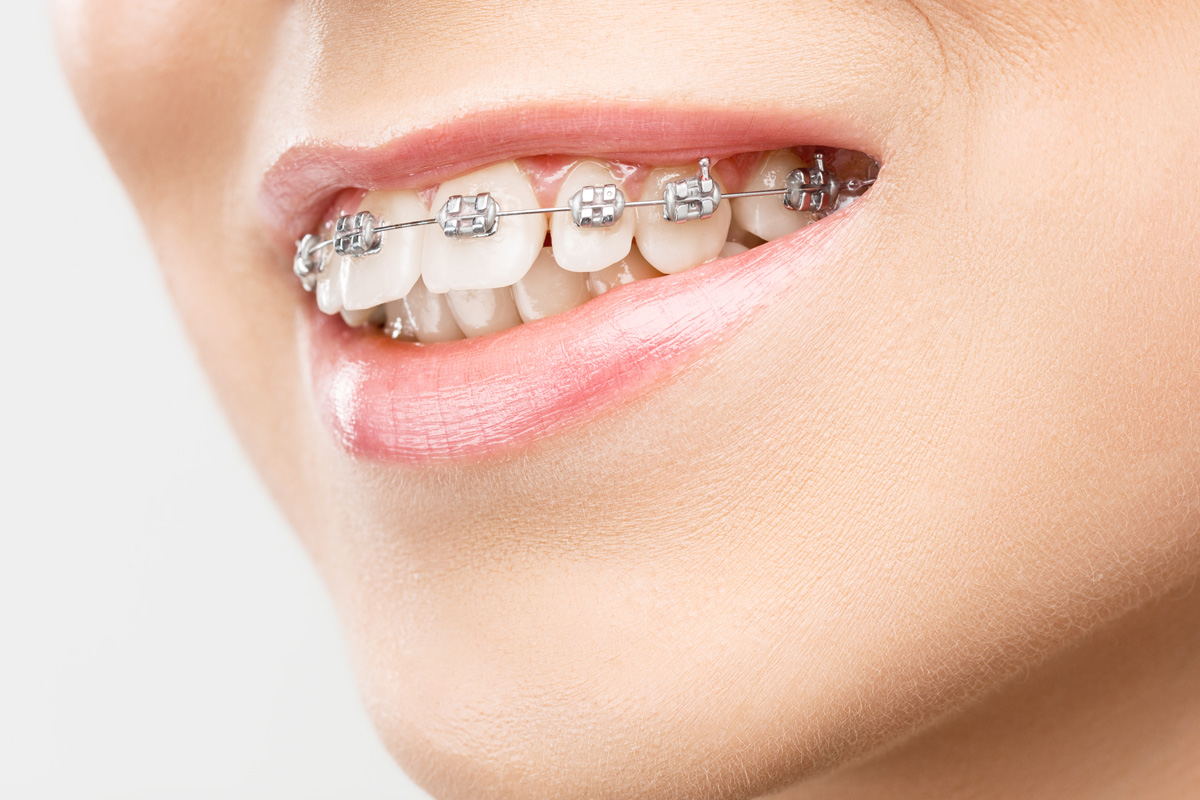 みまや歯科クリニック 前歯だけのプチ矯正