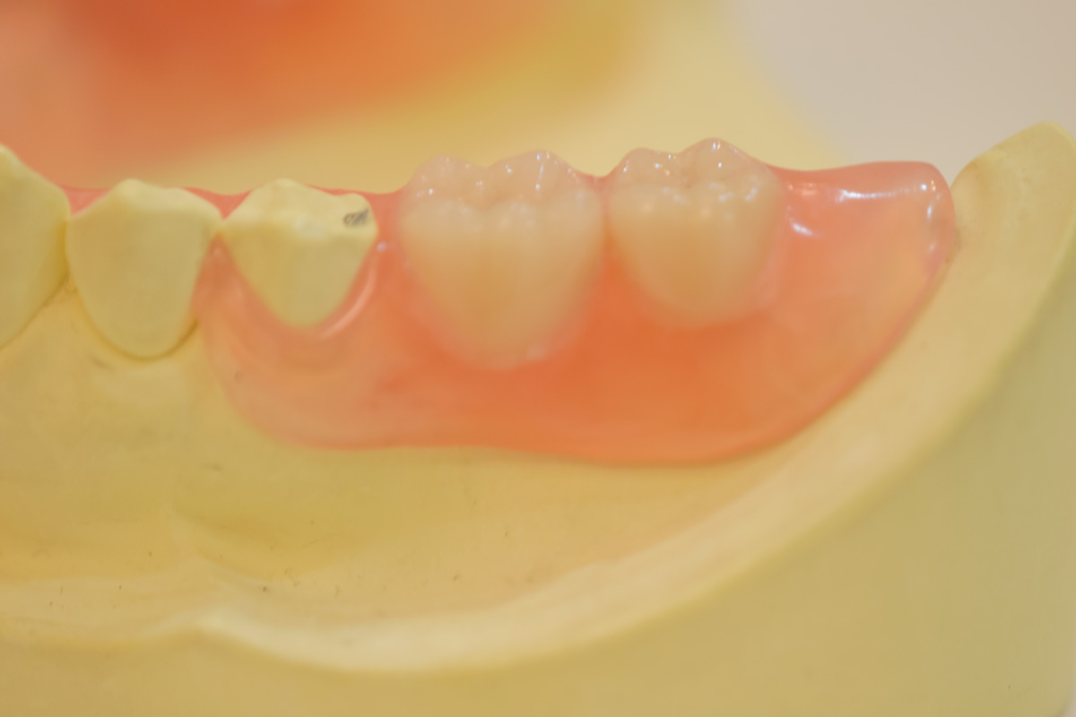 みまや歯科クリニック シリコーン義歯