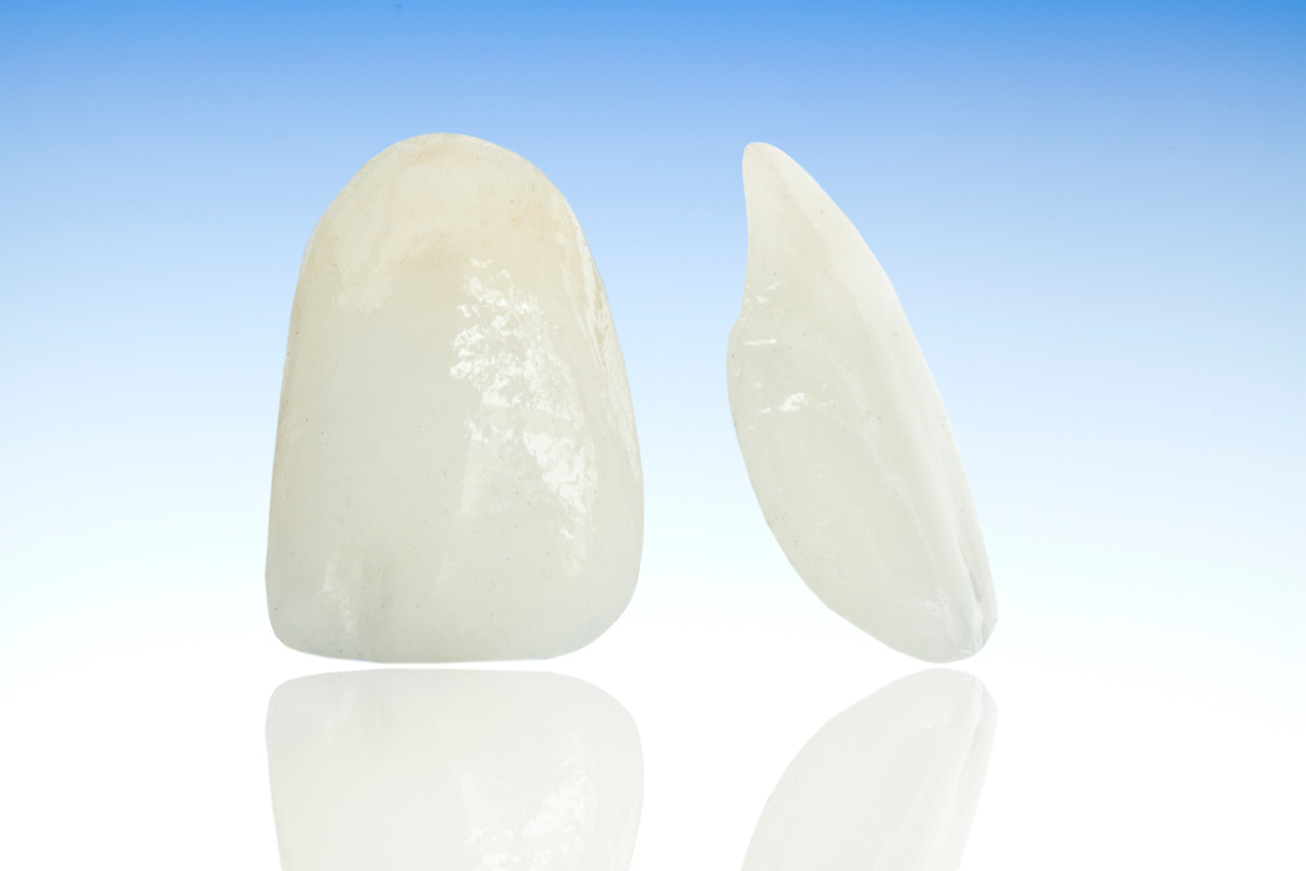 みまや歯科クリニック セラミックべニア（ラミネートべニア）