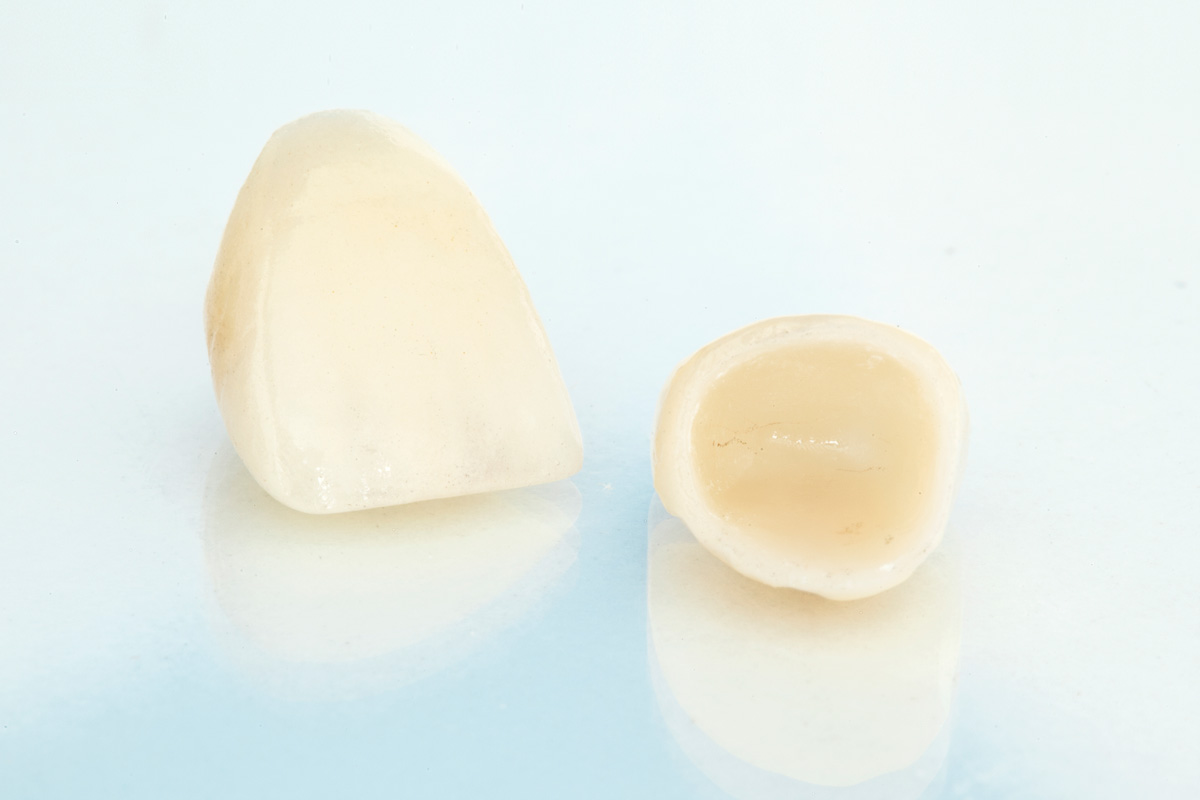 みまや歯科クリニック セラミックべニア（ラミネートべニア）